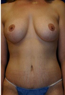 Lake County Plastic Surgery (Aras D. Tijunelis, MD) mommy makeover after — Libertyville, IL