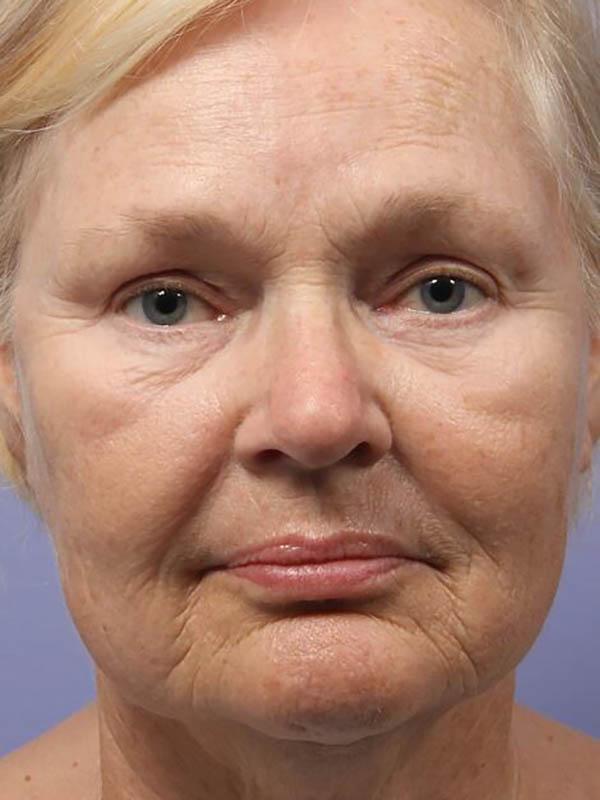 Deep Plane Facelift before at Marina Plastic Surgery in Pasadena, CA