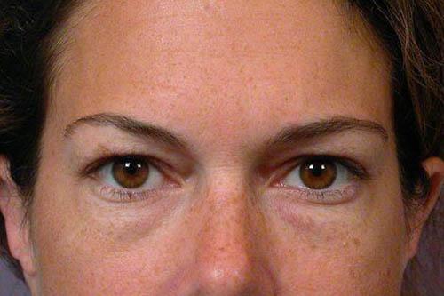 Blepharoplasty before at Marina Plastic Surgery in Pasadena, CA