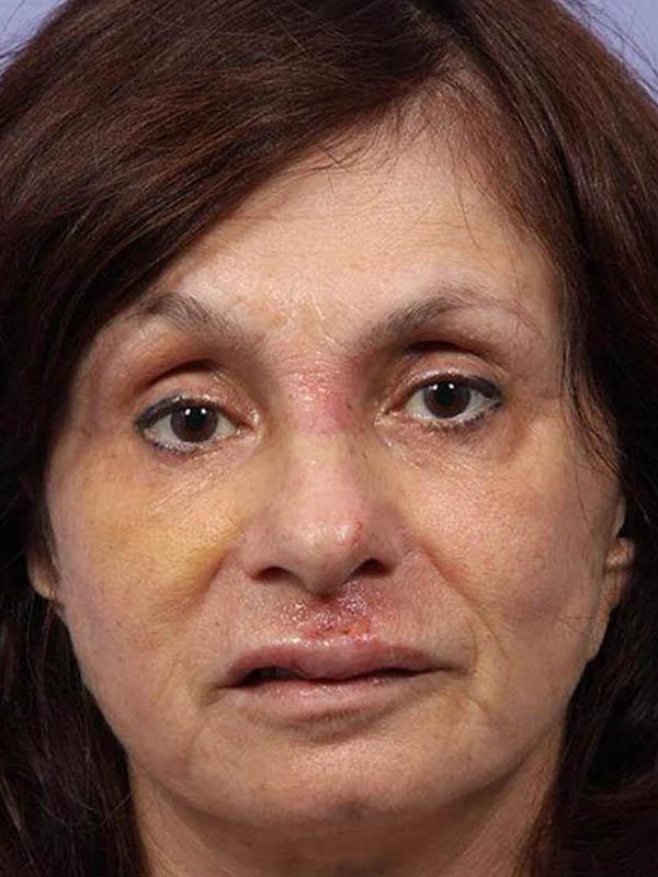 Functional Rhinoplasty before at Marina Plastic Surgery in Pasadena, CA