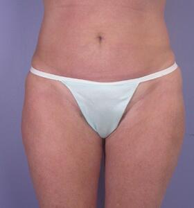 Liposuction after at Marina Plastic Surgery in Los Angeles, CA