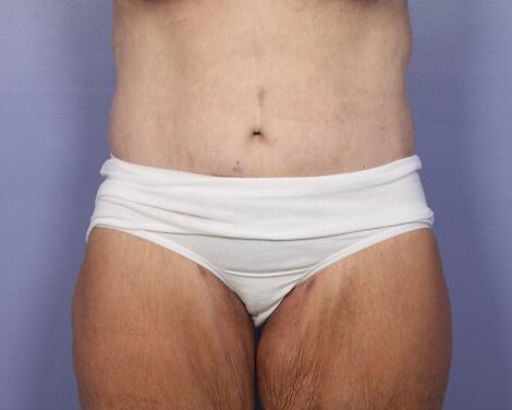 Tummy Tuck after at Marina Plastic Surgery in Los Angeles, CA