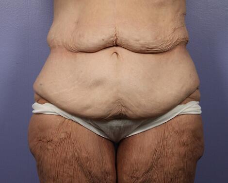 Tummy Tuck before at Marina Plastic Surgery in Los Angeles, CA