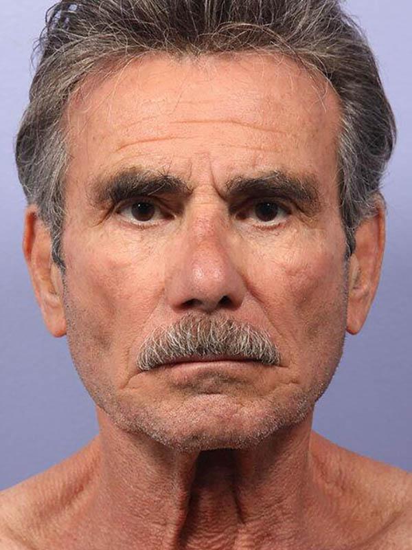 Facelift before at Marina Plastic Surgery in Los Angeles, CA