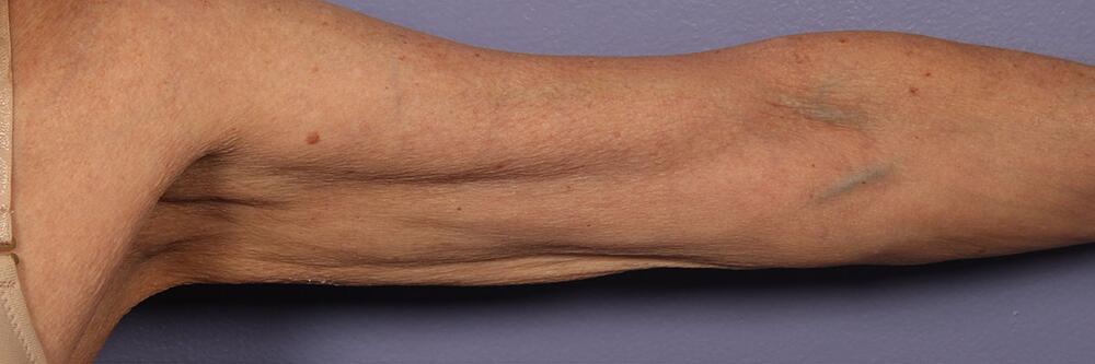 Marina Plastic Surgery skin tightening result — Los Angeles, CA