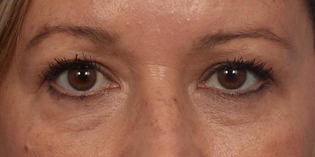 Botox result at Marina Plastic Surgery in Los Angeles, CA