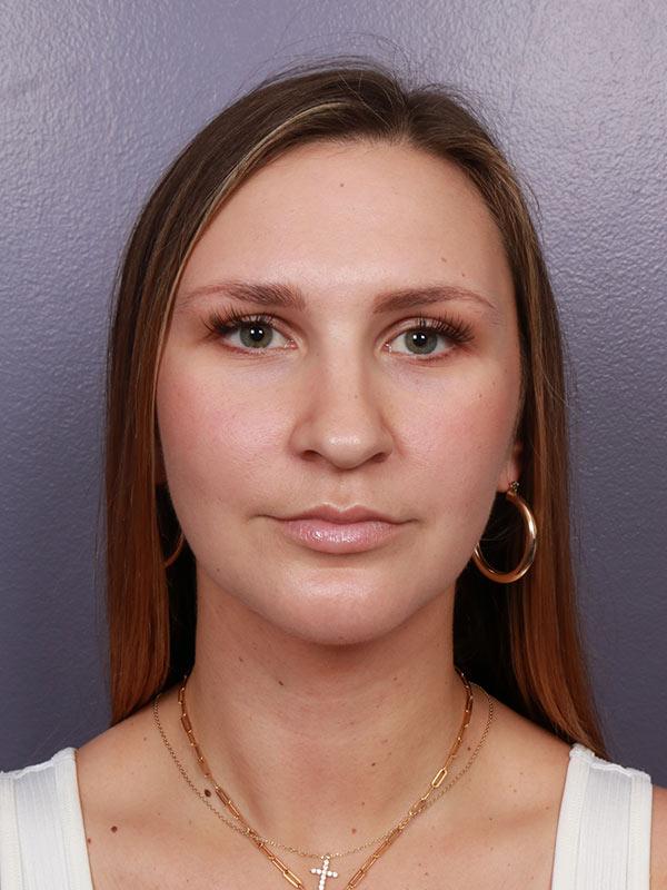 Neck Lift after at Marina Plastic Surgery in Los Angeles, CA