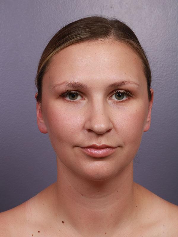 Neck Lift before at Marina Plastic Surgery in Los Angeles, CA