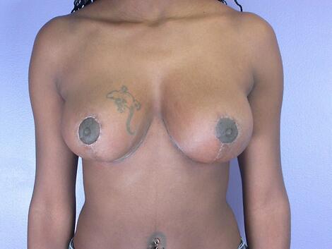 Breast Lift after at Marina Plastic Surgery in Los Angeles, CA