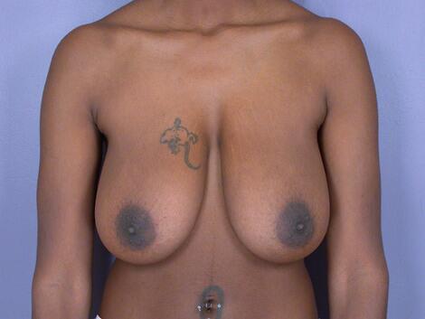 Breast Lift before at Marina Plastic Surgery in Los Angeles, CA