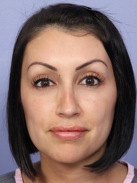 Functional Rhinoplasty after at Marina Plastic Surgery in Pasadena, CA