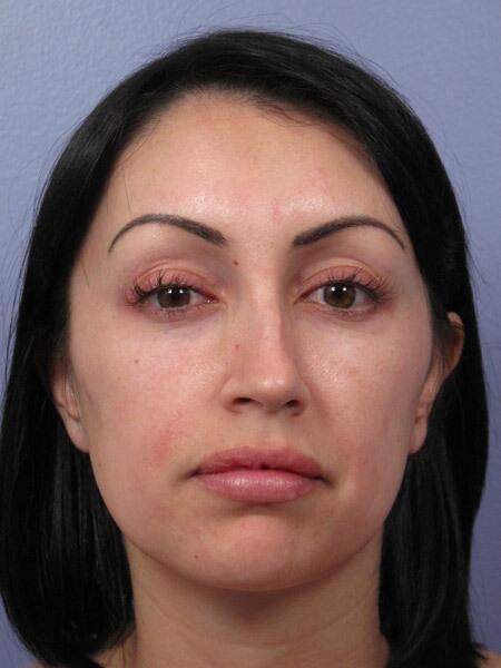 Functional Rhinoplasty before at Marina Plastic Surgery in Pasadena, CA