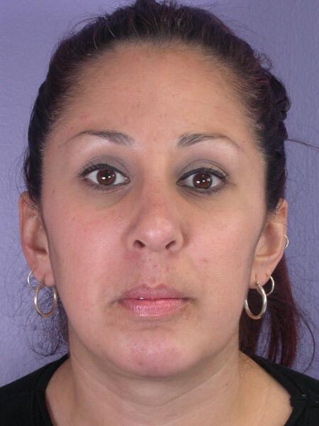 Functional Rhinoplasty after at Marina Plastic Surgery in Pasadena, CA