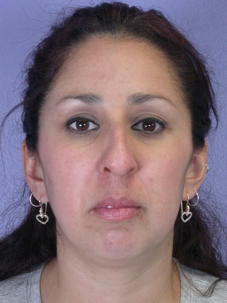 Functional Rhinoplasty before at Marina Plastic Surgery in Pasadena, CA