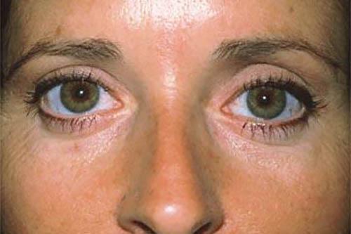 Blepharoplasty after at Marina Plastic Surgery in Pasadena, CA