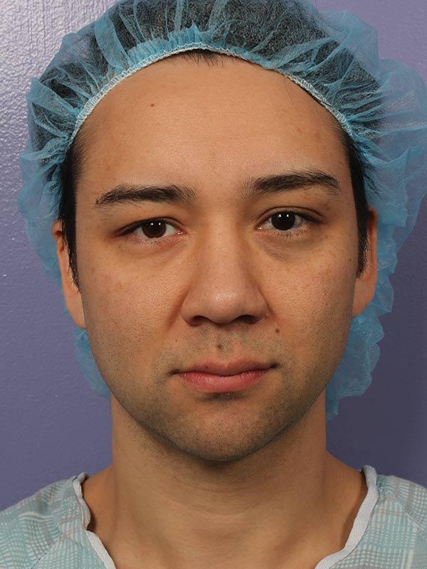 Neck Lift before at Marina Plastic Surgery in Pasadena, CA