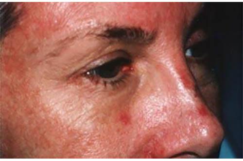 Blepharoplasty before at Marina Plastic Surgery in Pasadena, CA