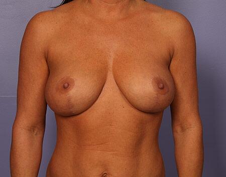 Breast Lift after at Marina Plastic Surgery in Pasadena, CA