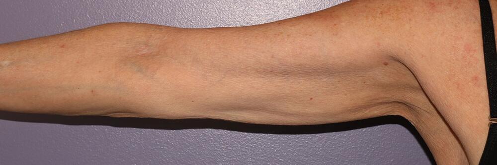 Marina Plastic Surgery skin tightening result — Los Angeles, CA