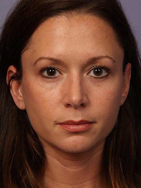 Rhinoplasty after at Marina Plastic Surgery in Los Angeles, CA