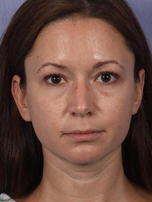 Rhinoplasty before at Marina Plastic Surgery in Los Angeles, CA