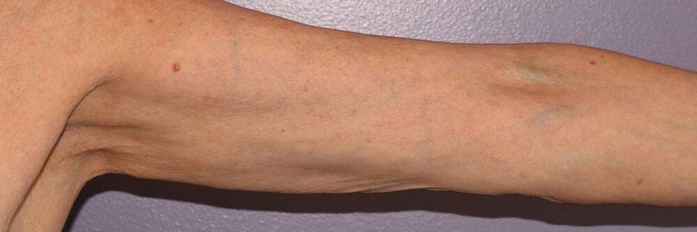 Marina Plastic Surgery skin tightening result — Los Angeles, CA