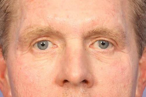 Blepharoplasty after at Marina Plastic Surgery in Pasadena, CA