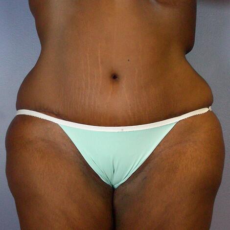 Tummy Tuck after at Marina Plastic Surgery in Los Angeles, CA
