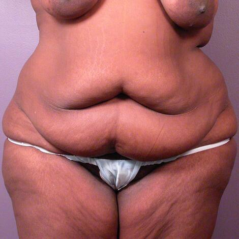 Tummy Tuck before at Marina Plastic Surgery in Los Angeles, CA
