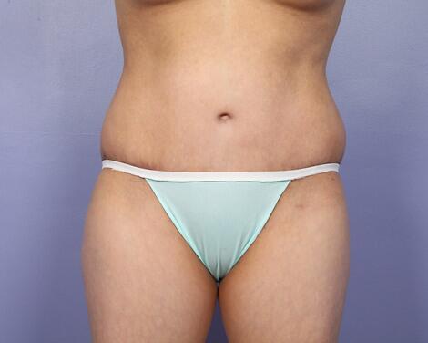 Mini Tummy Tuck after at Marina Plastic Surgery in Pasadena, CA