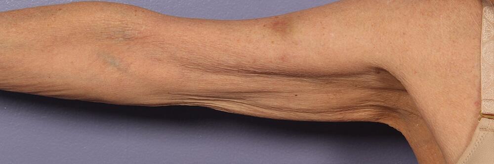 Marina Plastic Surgery skin tightening result — Los Angeles, CA
