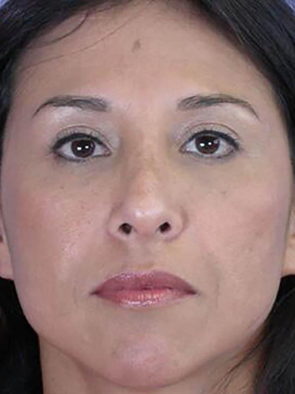 Functional Rhinoplasty after at Marina Plastic Surgery in Pasadena, CA