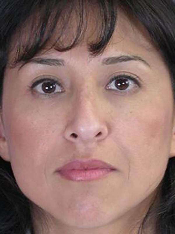 Functional Rhinoplasty before at Marina Plastic Surgery in Pasadena, CA