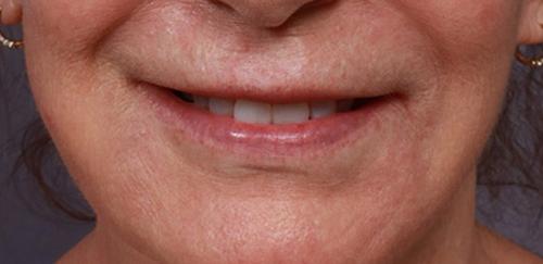 Marina Plastic Surgery lip lift result — Los Angeles, CA