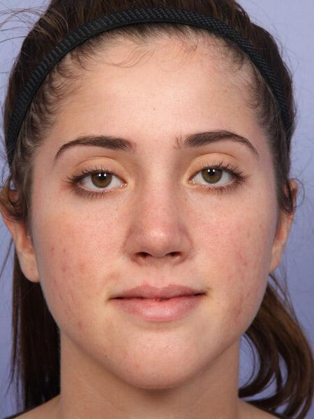 Functional Rhinoplasty after at Marina Plastic Surgery in Pasadena, CA