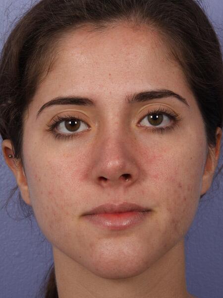 Functional Rhinoplasty before at Marina Plastic Surgery in Pasadena, CA