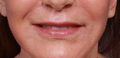 Marina Plastic Surgery lip lift result — Los Angeles, CA