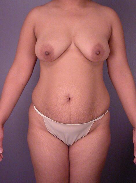 Mommy Makeover before at Marina Plastic Surgery in Los Angeles, CA
