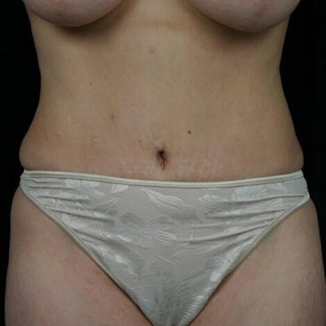 Mini Tummy Tuck after at Marina Plastic Surgery in Pasadena, CA