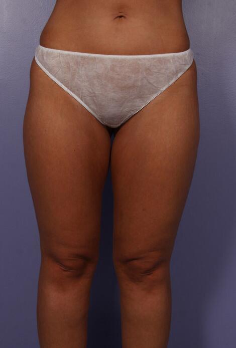 Marina Plastic Surgery liposuction after — Los Angeles, CA