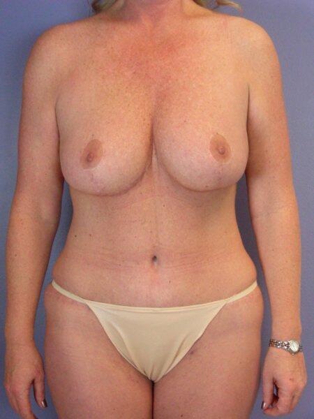 Mommy Makeover after at Marina Plastic Surgery in Los Angeles, CA