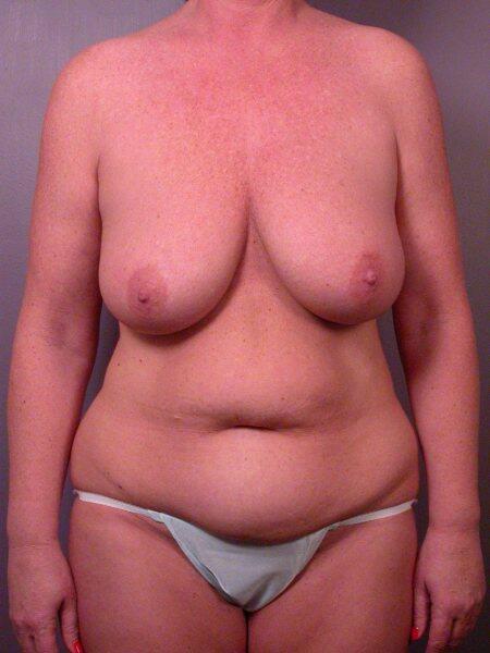 Mommy Makeover before at Marina Plastic Surgery in Los Angeles, CA