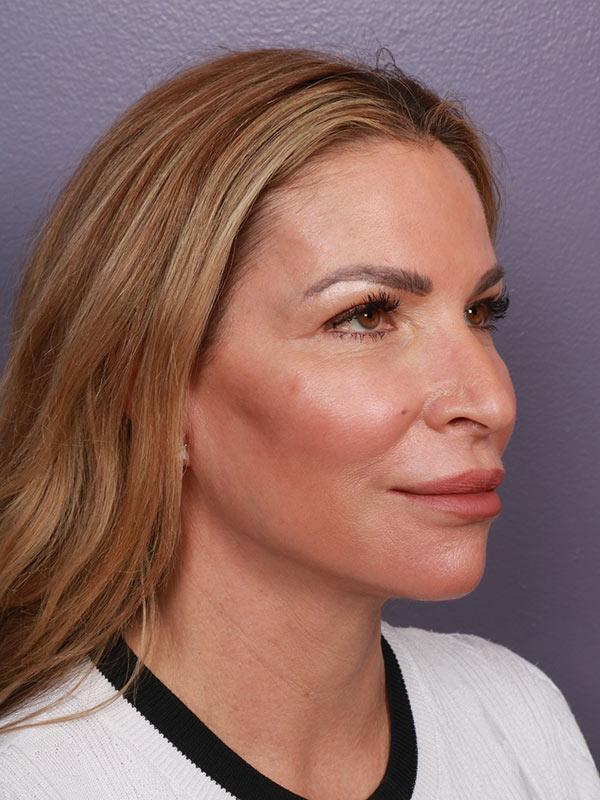 Neck Lift after at Marina Plastic Surgery in Los Angeles, CA