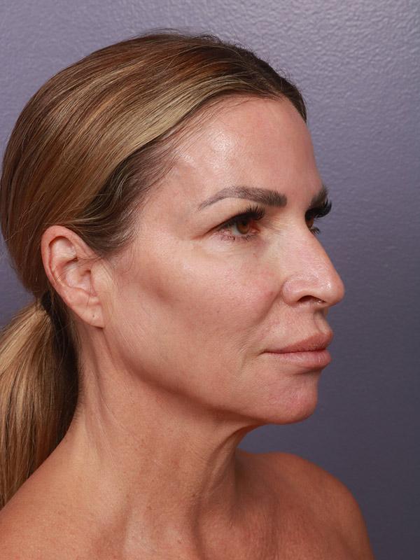 Neck Lift before at Marina Plastic Surgery in Los Angeles, CA