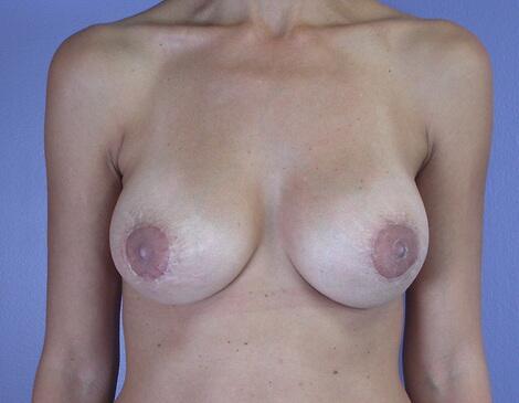 Mommy Makeover after at Marina Plastic Surgery in Los Angeles, CA