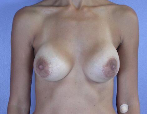 Mommy Makeover before at Marina Plastic Surgery in Los Angeles, CA