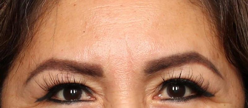 Dr. William Harris - Harris Facial Plastic Surgery & Aesthetics eyelid lift after — Beverly Hills, CA