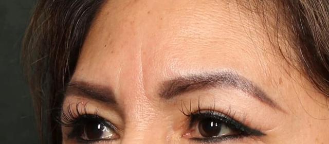 Blepharoplasty after at Dr. William Harris - Harris Facial Plastic Surgery & Aesthetics in Beverly Hills, CA