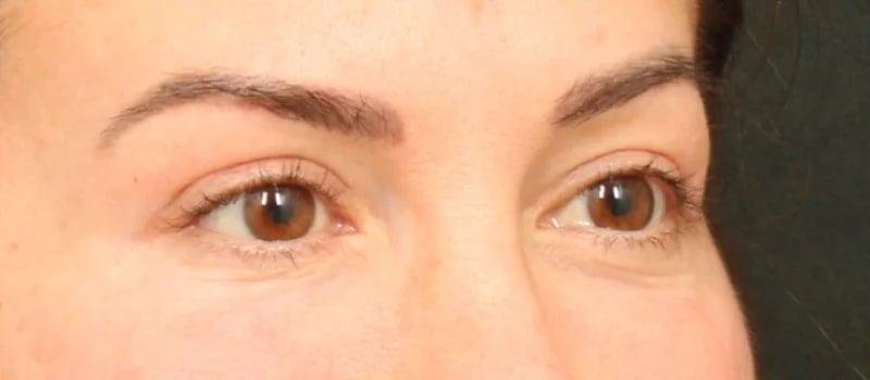 Dr. William Harris - Harris Facial Plastic Surgery & Aesthetics blepharoplasty result — Beverly Hills, CA