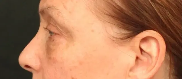Brow Lift before at Dr. William Harris - Harris Facial Plastic Surgery & Aesthetics in Beverly Hills, CA